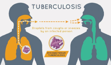Target to end TB by 2025