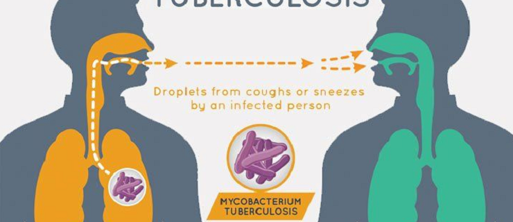 Target to end TB by 2025