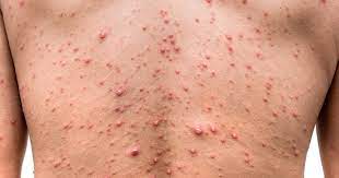 chicken pox